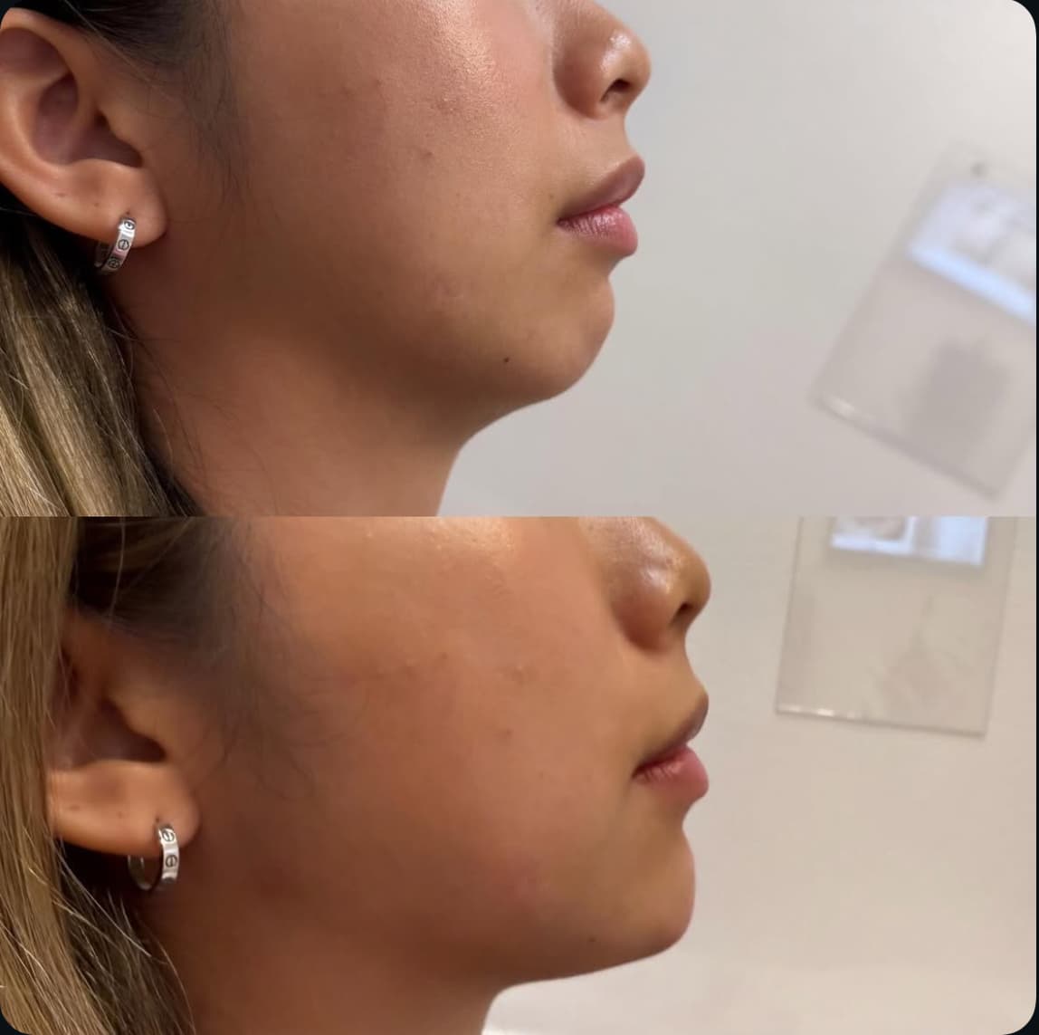 After: Facial Rejuvenation