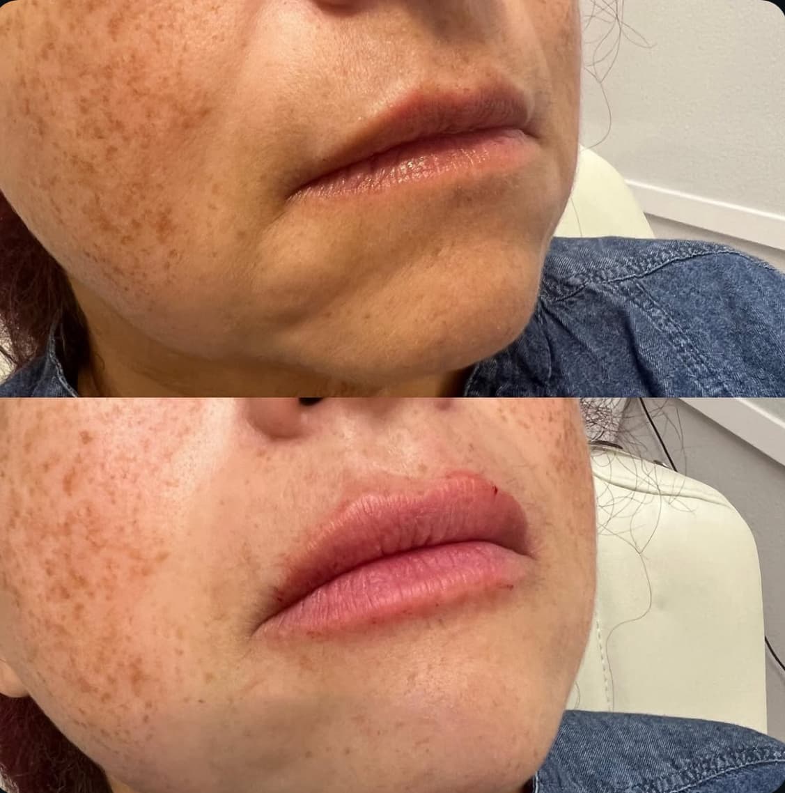 Before: Facial Rejuvenation